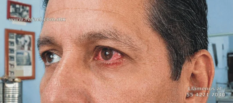 Trabajador presenta lesión ocular por proyección de partícula metálica en el ojo