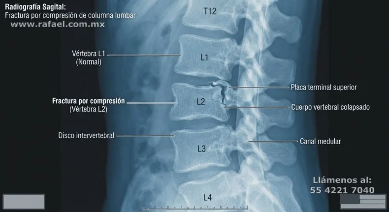 Ejemplo del daño en columna vertebral de un trabajador, en la radiografía se muestra una fractura por compresión en la 
         vértebra L12, resultado del levantamiento excesivo de carga.